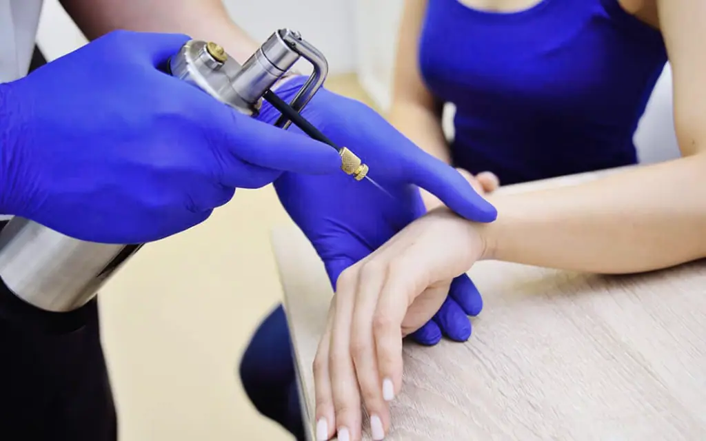 Liquid nitrogen cryotherapy treatment at Great Lakes Skin Clinic